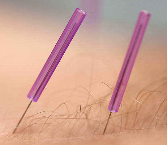 Akupunktur nåle